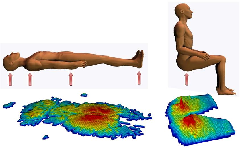 L. Baar Orthopädietechnik GmbH - Was ist ein Dekubitus?
